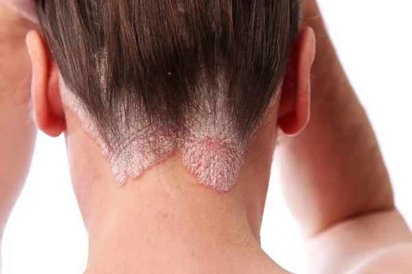 photo du cuir chevelu d'une femme atteinte de psoriasis, plaque de peau blanchâtre et sèche 